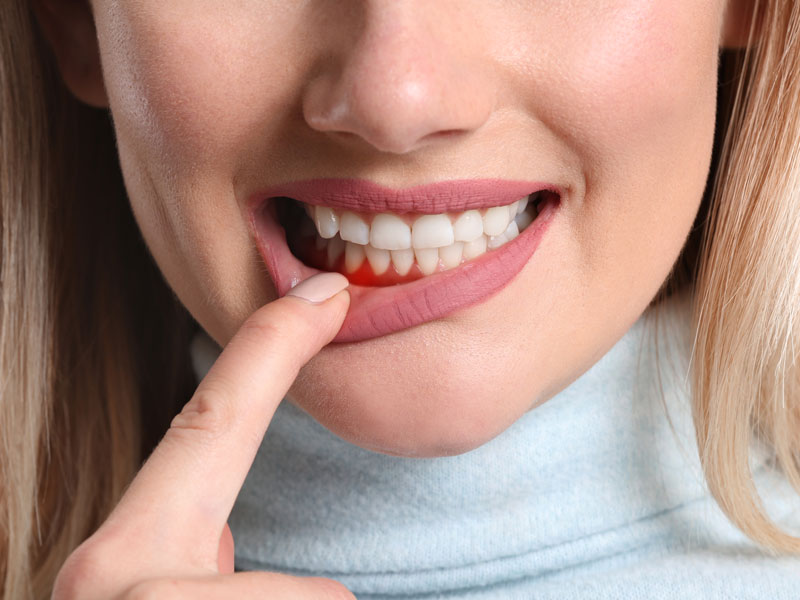 Patient with Inflamed Gums